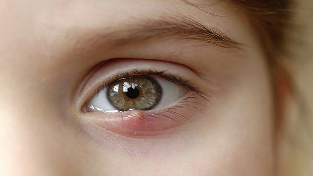 Những nguyên nhân gây ra tình trạng lẹo mắt